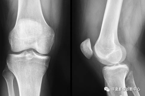 X线上股骨外侧髁深沟征-1