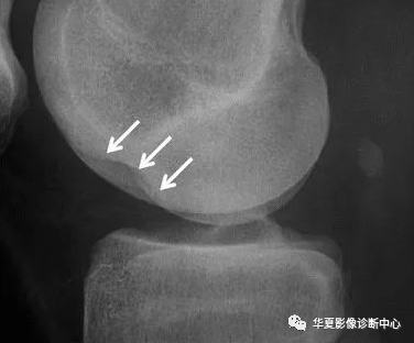 X线上股骨外侧髁深沟征-2