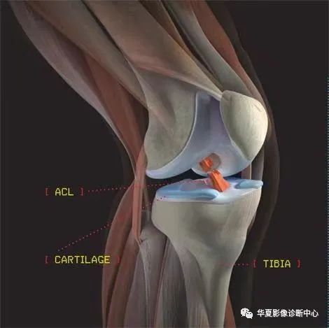 X线上股骨外侧髁深沟征-4