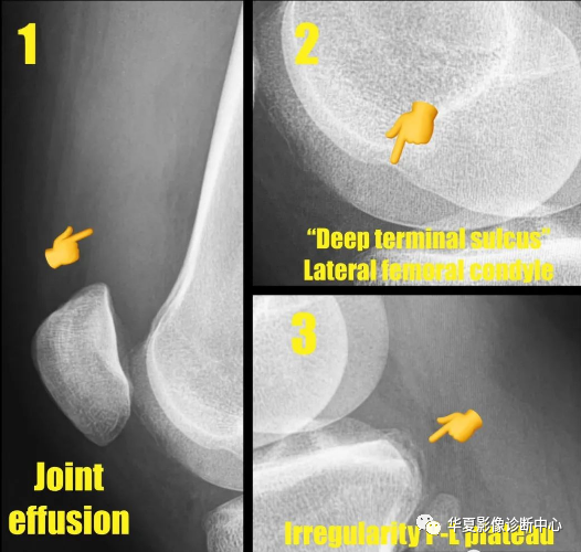 X线上股骨外侧髁深沟征-3