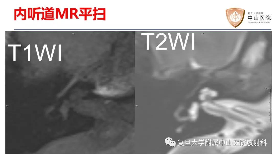 【病例】内淋巴积水(梅尼埃病)一例MR影像-3