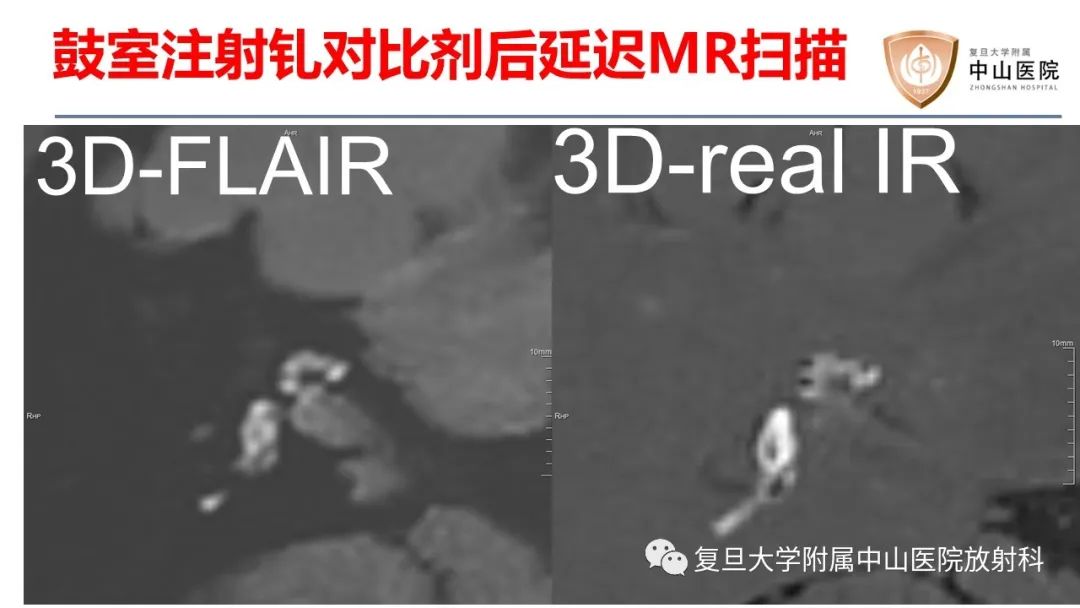 【病例】内淋巴积水(梅尼埃病)一例MR影像-4