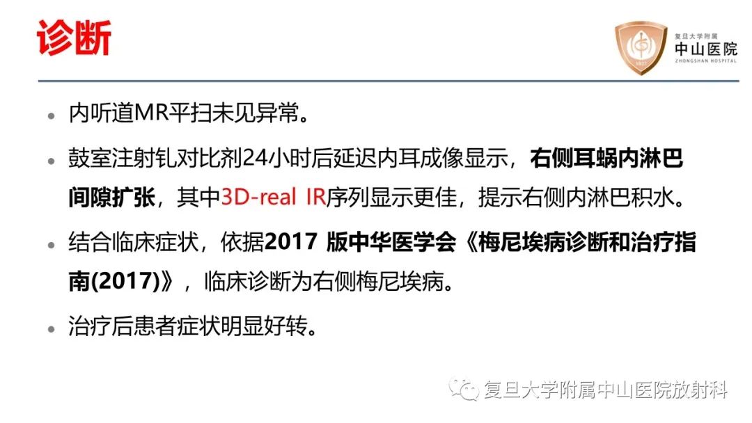 【病例】内淋巴积水(梅尼埃病)一例MR影像-6