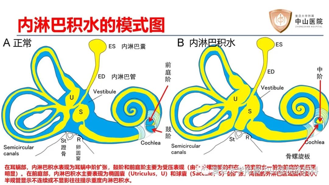 【病例】内淋巴积水(梅尼埃病)一例MR影像-10