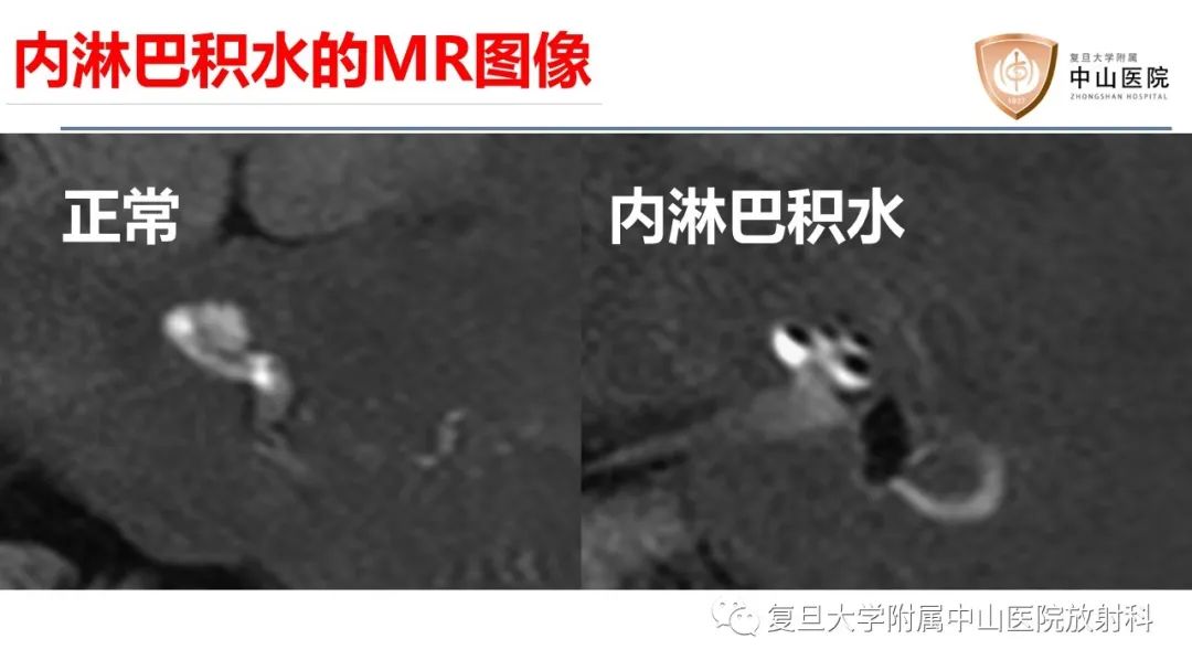 【病例】内淋巴积水(梅尼埃病)一例MR影像-11
