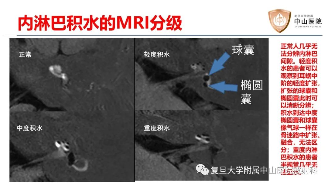 【病例】内淋巴积水(梅尼埃病)一例MR影像-12