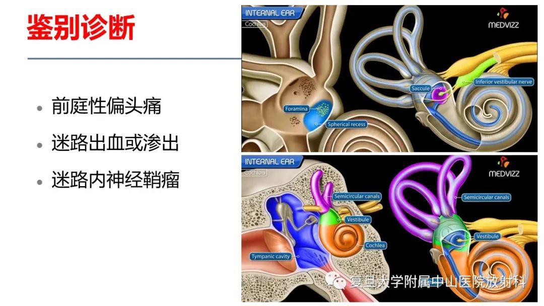 【病例】内淋巴积水(梅尼埃病)一例MR影像-13