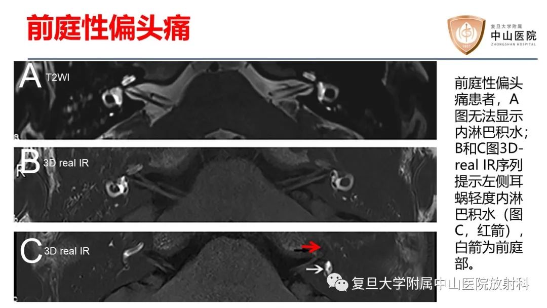 【病例】内淋巴积水(梅尼埃病)一例MR影像-15
