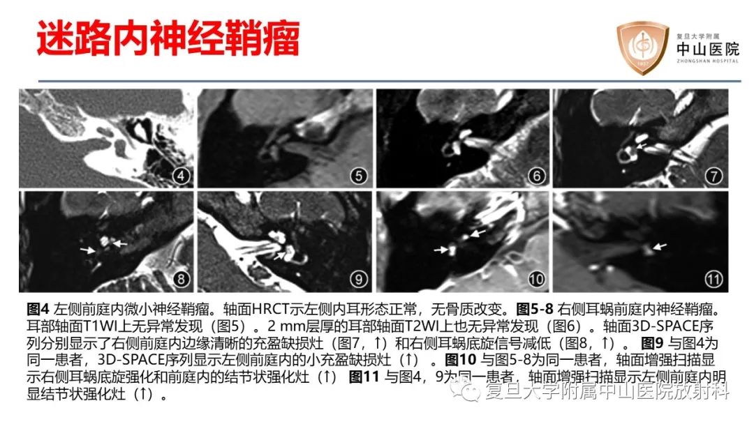 【病例】内淋巴积水(梅尼埃病)一例MR影像-17