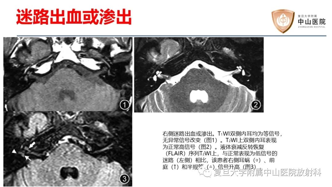 【病例】内淋巴积水(梅尼埃病)一例MR影像-19
