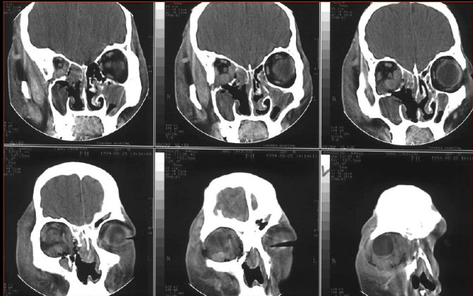 鼻窦炎影像诊断-1 鼻窦炎影像诊断-1