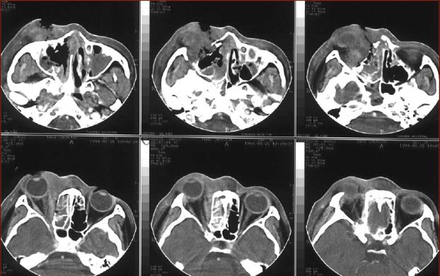 鼻窦炎影像诊断-2 鼻窦炎影像诊断-2
