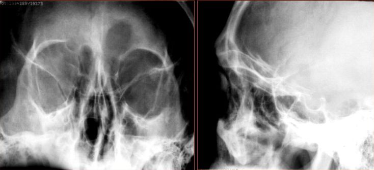 鼻窦炎影像诊断-5 鼻窦炎影像诊断-5