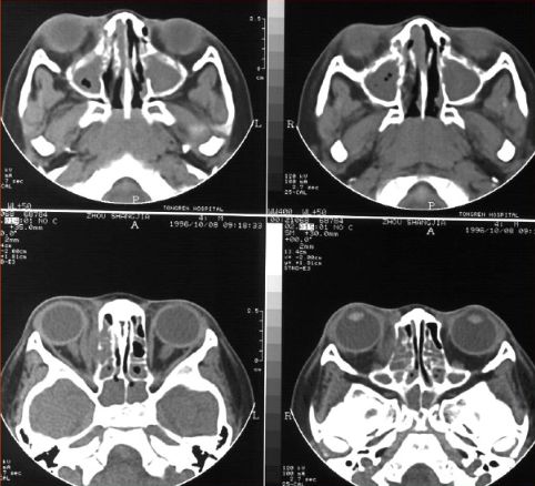 鼻窦炎影像诊断-3 鼻窦炎影像诊断-3