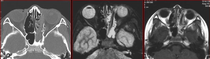 鼻窦炎影像诊断-4 鼻窦炎影像诊断-4