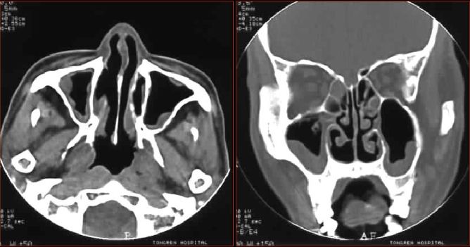 鼻窦炎影像诊断-6 鼻窦炎影像诊断-6