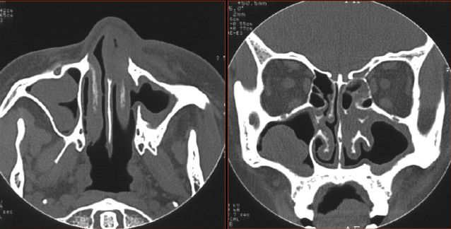 鼻窦炎影像诊断-7 鼻窦炎影像诊断-7