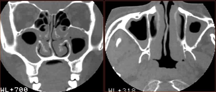 鼻窦炎影像诊断-8 鼻窦炎影像诊断-8