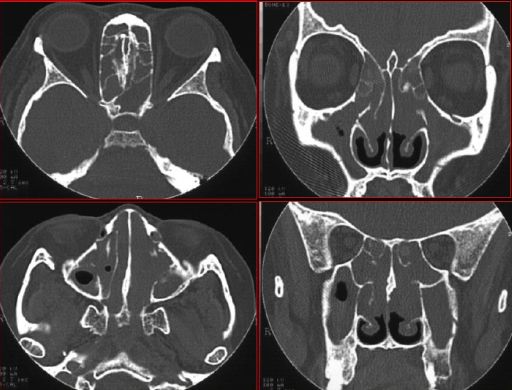 鼻窦炎影像诊断-9 鼻窦炎影像诊断-9