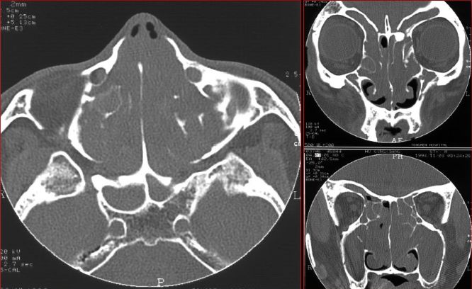 鼻窦炎影像诊断-10 鼻窦炎影像诊断-10
