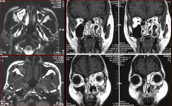 鼻窦炎影像诊断-11 鼻窦炎影像诊断-11