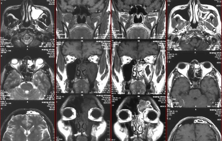 鼻窦炎影像诊断-12 鼻窦炎影像诊断-12