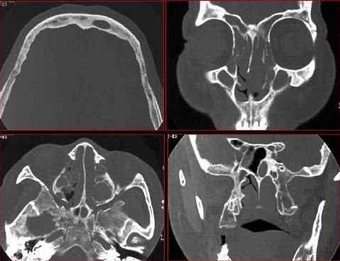 鼻窦炎影像诊断-13 鼻窦炎影像诊断-13