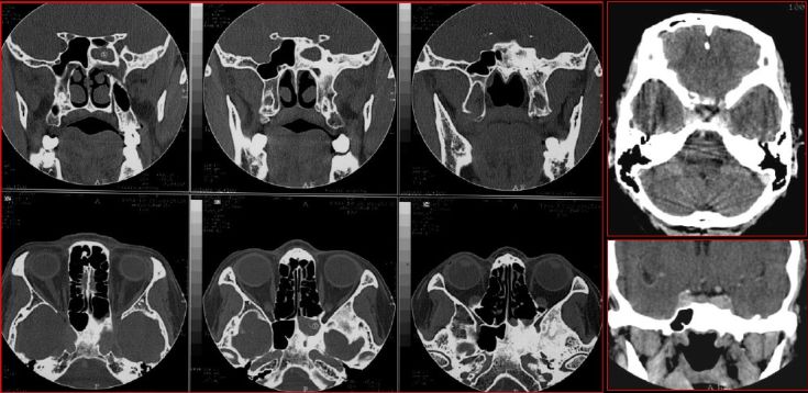 鼻窦炎影像诊断-14 鼻窦炎影像诊断-14
