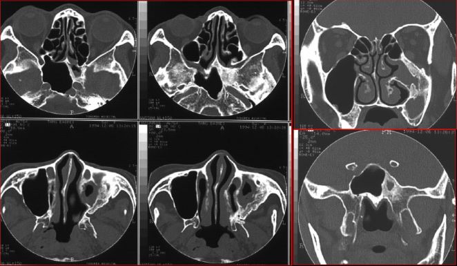 鼻窦炎影像诊断-15 鼻窦炎影像诊断-15