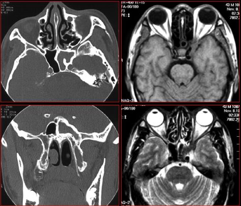 鼻窦炎影像诊断-16 鼻窦炎影像诊断-16