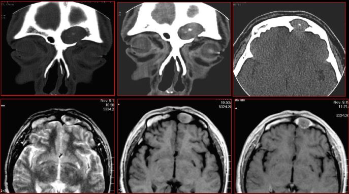 鼻窦炎影像诊断-18 鼻窦炎影像诊断-18