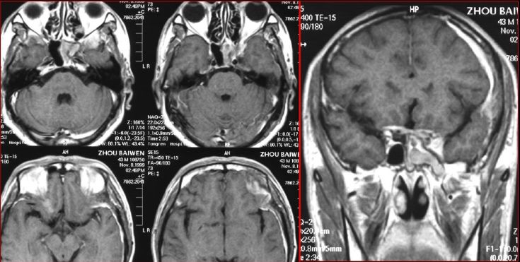 鼻窦炎影像诊断-17 鼻窦炎影像诊断-17