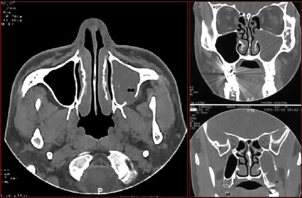 鼻窦炎影像诊断-19 鼻窦炎影像诊断-19