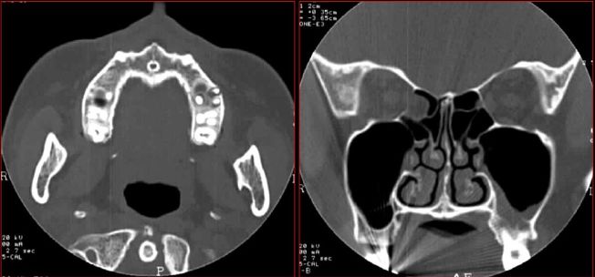 鼻窦炎影像诊断-20 鼻窦炎影像诊断-20