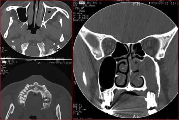 鼻窦炎影像诊断-21 鼻窦炎影像诊断-21