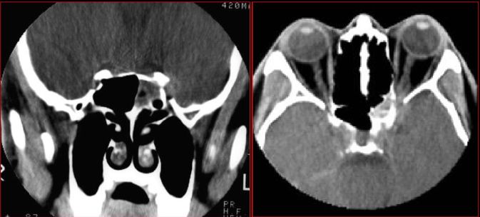 鼻窦炎影像诊断-22 鼻窦炎影像诊断-22