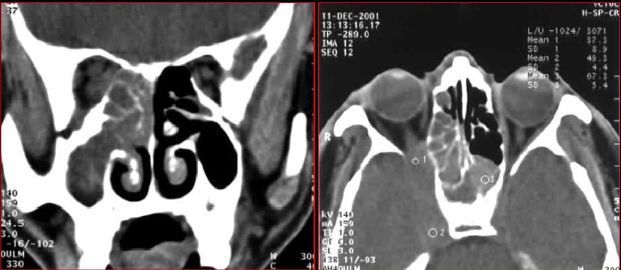鼻窦炎影像诊断-23 鼻窦炎影像诊断-23