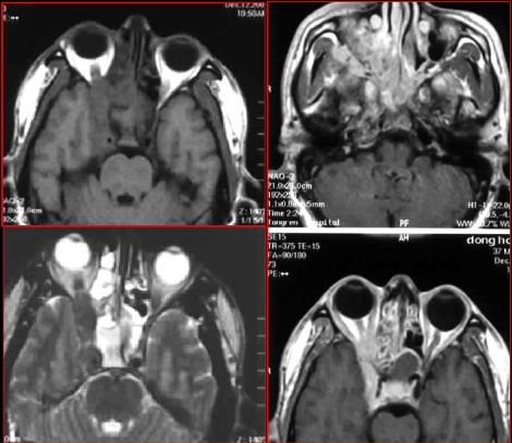 鼻窦炎影像诊断-24 鼻窦炎影像诊断-24