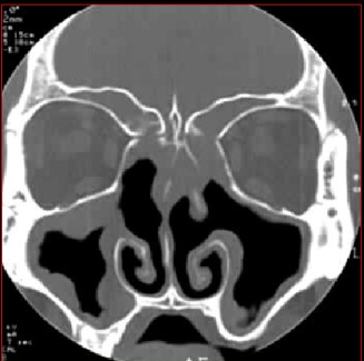 鼻窦炎影像诊断-25 鼻窦炎影像诊断-25
