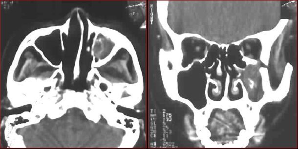 鼻窦炎影像诊断-26 鼻窦炎影像诊断-26