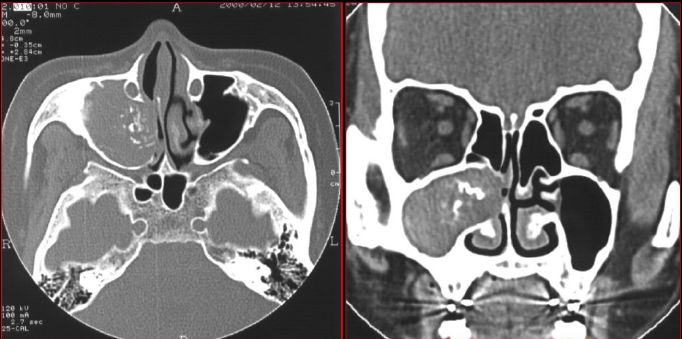 鼻窦炎影像诊断-27 鼻窦炎影像诊断-27