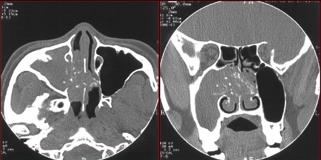 鼻窦炎影像诊断-28 鼻窦炎影像诊断-28