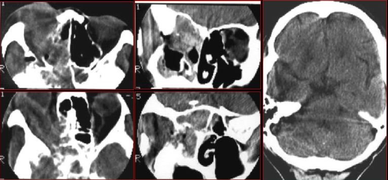 鼻窦炎影像诊断-29 鼻窦炎影像诊断-29
