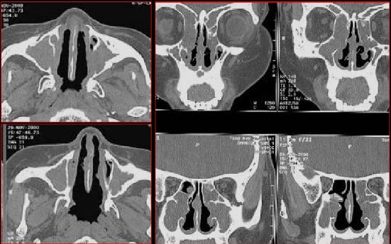 鼻窦炎影像诊断-30 鼻窦炎影像诊断-30