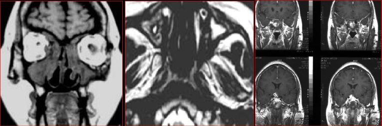 鼻窦炎影像诊断-31