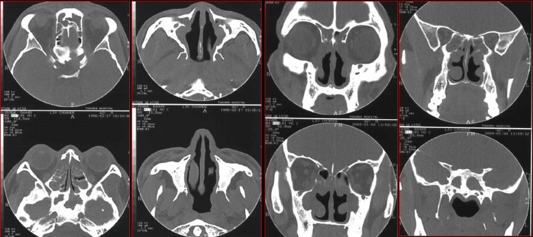 鼻窦炎影像诊断-32 鼻窦炎影像诊断-32
