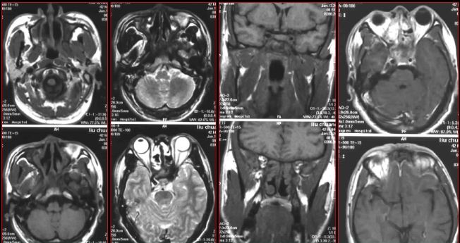 鼻窦炎影像诊断-33 鼻窦炎影像诊断-33