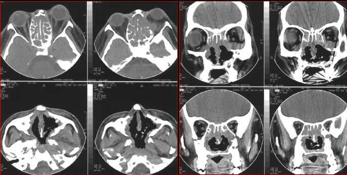 鼻窦炎影像诊断-34 鼻窦炎影像诊断-34