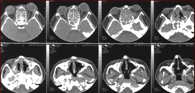 鼻窦炎影像诊断-35 鼻窦炎影像诊断-35