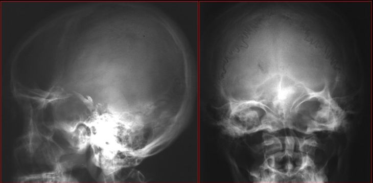 鼻窦炎影像诊断-36 鼻窦炎影像诊断-36